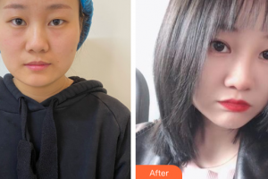 佛山美嘉美醫(yī)療美容門(mén)診部樸善在整形價(jià)格表附埋線雙眼皮案例展示