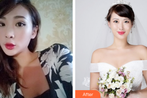 佛山廣美醫(yī)療美容門(mén)診部羅雄鵬整形價(jià)格表附鼻部手術(shù)案例展示