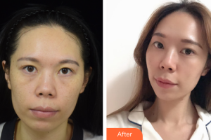 佛山廣美醫(yī)療美容門(mén)診部楊群鳳整形價(jià)格表附熱拉提緊致除皺案例展示