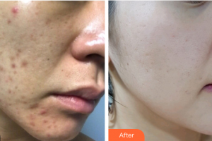 佛山顏植醫(yī)療美容門(mén)診部曾碧江整形價(jià)格表附微針祛痘坑痘印案例展示