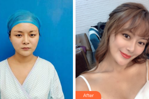 佛山東康整形美容門(mén)診部何鎮(zhèn)宇整形價(jià)格表附五維錨定眼部手術(shù)案例展示