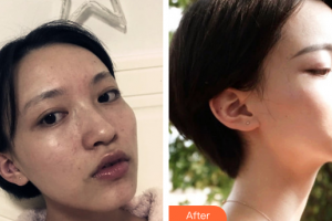 佛山黛顏人醫(yī)療美容門(mén)診部鄧勝群整形價(jià)格表附水光補(bǔ)水案例展示