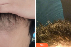 佛山廣文皮膚科醫(yī)院楊利兵整形價(jià)格表附種植發(fā)際線案例展示