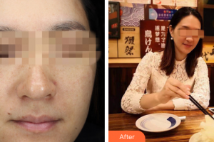 佛山廣文皮膚科醫(yī)院孫光選整形價(jià)格表附光子嫩膚案例展示