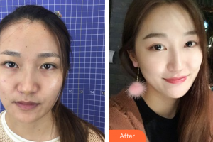 佛山美萊醫(yī)療美容醫(yī)院王燕整形價(jià)格表附鼻部手術(shù)案例展示