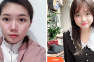 佛山廣大壹美醫(yī)療美容門診部曹壁浪整形價格表附雙眼皮案例展示