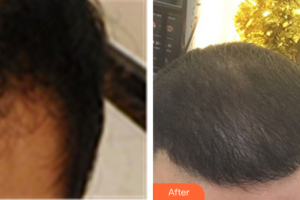 佛山廣大壹美醫(yī)療美容門診部李青輝整形價格表附種植發(fā)際線案例展示