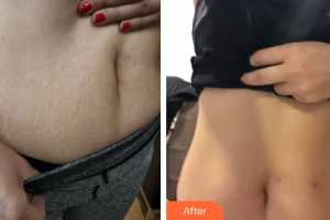 佛山廣大壹美醫(yī)療美容門診部謝舜賢整形價格表附祛妊娠紋案例展示