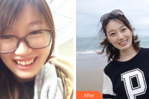 佛山順德口腔醫(yī)院吳蘭萍整形價格表附金屬矯正案例展示