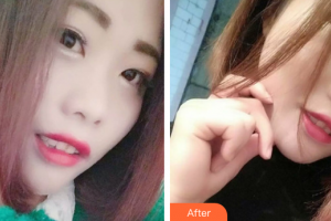 佛山南海中大口腔醫(yī)院吳成坤整形價格表附超聲波洗牙案例展示