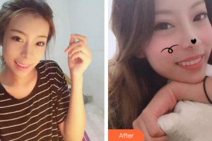 佛山市禪城區(qū)人民醫(yī)院口腔?？漆t(yī)院關(guān)達(dá)榮整形價(jià)格表附隱形矯正案例展示