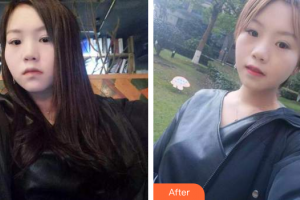 佛山市禪城區(qū)人民醫(yī)院口腔?？漆t(yī)院陳月明整形價格表附時代天使矯正案例展示