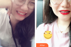 佛山市禪城區(qū)人民醫(yī)院口腔?？漆t(yī)院鄒康元整形價(jià)格表附金屬矯正案例展示