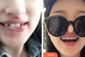 佛山南海中大口腔醫(yī)院謝建雅整形價(jià)格表附金屬矯正案例展示