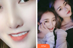 佛山順德口腔醫(yī)院吳龍華整形價(jià)格表附瓷貼面案例展示