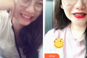 佛山市禪城區(qū)人民醫(yī)院口腔?？漆t(yī)院李業(yè)榮整形價(jià)格表附金屬矯正案例展示