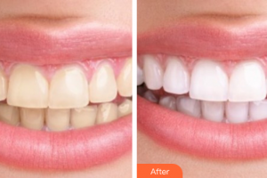 佛山南海中大口腔醫(yī)院葉文科整形價(jià)格表附冷光美白案例展示