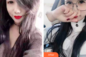 佛山市禪城區(qū)人民醫(yī)院口腔專科醫(yī)院符鎮(zhèn)南整形價(jià)格表附時(shí)代天使矯正案例展示