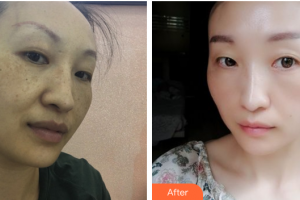 江門福康醫(yī)學(xué)整形美容醫(yī)院徐靖宏整形價(jià)格表附祛黃褐斑案例展示