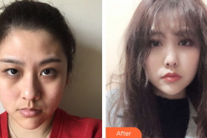 江門瑪麗整形醫(yī)院翁明飛整形價(jià)格表附激光去眼袋案例展示