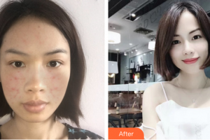 江門瑪麗整形醫(yī)院李慧瓊整形價(jià)格表附紅藍(lán)光祛痘案例展示