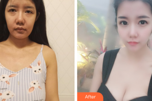 江門福康醫(yī)學(xué)整形美容醫(yī)院張志軍整形價(jià)格表附自體脂肪隆胸案例展示