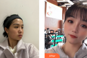 江門市五邑中醫(yī)院整形科李宇明整形價(jià)格表附埋線提升提升案例展示