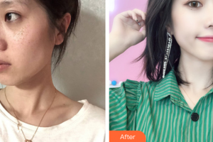 江門?？滇t(yī)學(xué)整形美容醫(yī)院蔡劍芳整形價(jià)格表附激光美膚激光祛斑案例展示