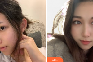 江門僑都華美美容醫(yī)院歐國(guó)升整形價(jià)格表附面部填充案例展示