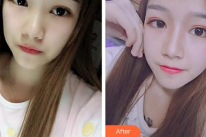 江門(mén)僑都華美美容醫(yī)院毛孝中整形價(jià)格表附耳軟骨復(fù)合隆鼻案例展示