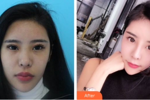 湛江名媛醫(yī)學(xué)美容門(mén)診部陳小利整形價(jià)格表附鼻整形案例展示