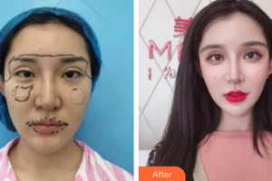 湛江澳泰整形美容醫(yī)院嚴(yán)鐘嫻整形價(jià)格表附埋線(xiàn)提升案例展示