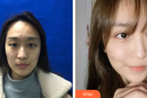 湛江華美整形美容醫(yī)院樊濤整形價(jià)格表附美眼案例展示