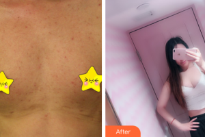 茂名華美整形美容醫(yī)院程國璽整形價(jià)格表附自體脂肪隆胸案例展示