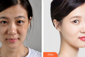 茂名市人民醫(yī)院燒傷整形科邱世國整形價(jià)格表附激光祛斑案例展示