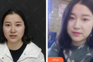 茂名市人民醫(yī)院燒傷整形科董永盛整形價(jià)格表附微針?biāo)獍咐故?>
</a>
<h3 class=