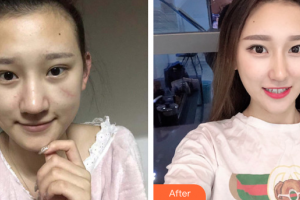 肇慶市第一人民醫(yī)院燒傷整形科姚明昌整形價(jià)格表附手術(shù)疤痕案例展示