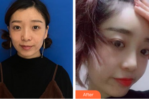 肇慶市高要區(qū)人民醫(yī)院整形激光美容科司義湘整形價(jià)格表附玻尿酸精華導(dǎo)入案例展示