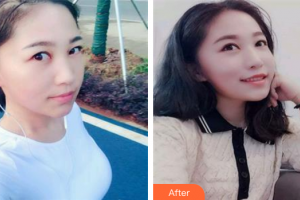 肇慶市皮膚病醫(yī)院醫(yī)療美容科韋方銓整形價格表附點(diǎn)陣激光祛妊娠紋案例展示