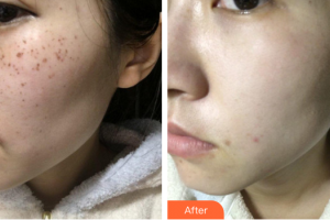 肇慶市皮膚病醫(yī)院醫(yī)療美容科吳曉紅整形價格表附美國蜂巢激光美膚祛斑案例展示