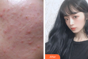 肇慶市皮膚病醫(yī)院醫(yī)療美容科何翠英整形價格表附微針?biāo)獍咐故?>
</a>
<h3 class=