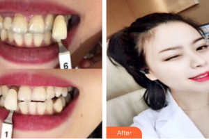 肇慶中大口腔醫(yī)院古善廷整形價格表附冷光美白案例展示