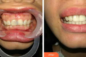 肇慶中大口腔醫(yī)院賴萬方整形價格表附美加超薄牙貼面案例展示