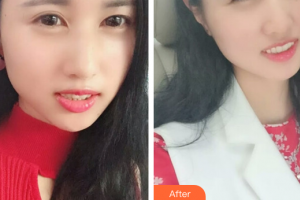 肇慶中大口腔醫(yī)院伍雪紅整形價格表附全瓷貼面案例展示