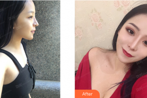 梅州市人民醫(yī)院燒傷整形科曾運(yùn)泉 整形價格表附假體隆胸案例展示