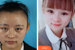 東莞中韓醫(yī)療美容診所劉琳整形價格表附眼部手術(shù)案例展示