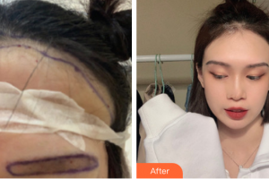 東莞康華醫(yī)院整形美容中心關(guān)志廣整形價格表附種植發(fā)際線案例展示