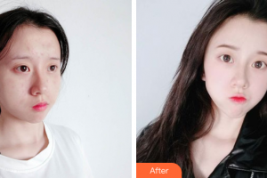 東莞市人民醫(yī)院醫(yī)學(xué)美容科整形價格表附祛痘案例展示