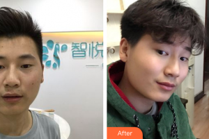 東莞市莞城人民醫(yī)院整形美容科羅少文整形價格表附激光祛痣案例展示