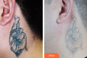 東莞知美整形醫(yī)院劉來君整形價格表附超激光美膚祛紋身案例展示